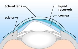 Gold Heart Optical Centre Dry Eye Management